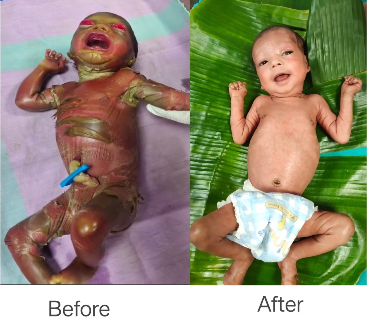 अत्यंत दुर्लभ बीमारी से जूझते शिशु को बचाया,केले के पत्तों से किया गया विशेष देखभाल